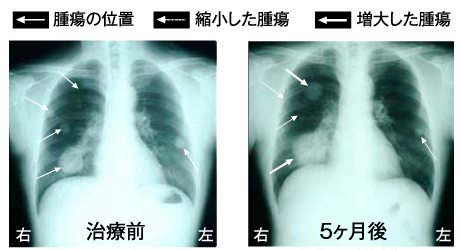 肝細胞がん、両側肺転移の45歳男性患者のレントゲン写真1